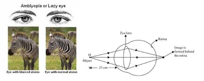 Eye Disease